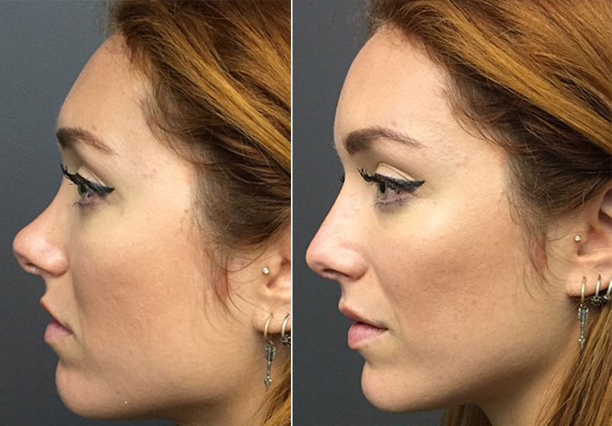 Rhinoplastie-Antes-Despues