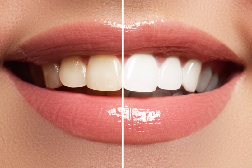 Blanqueamiento-Dental